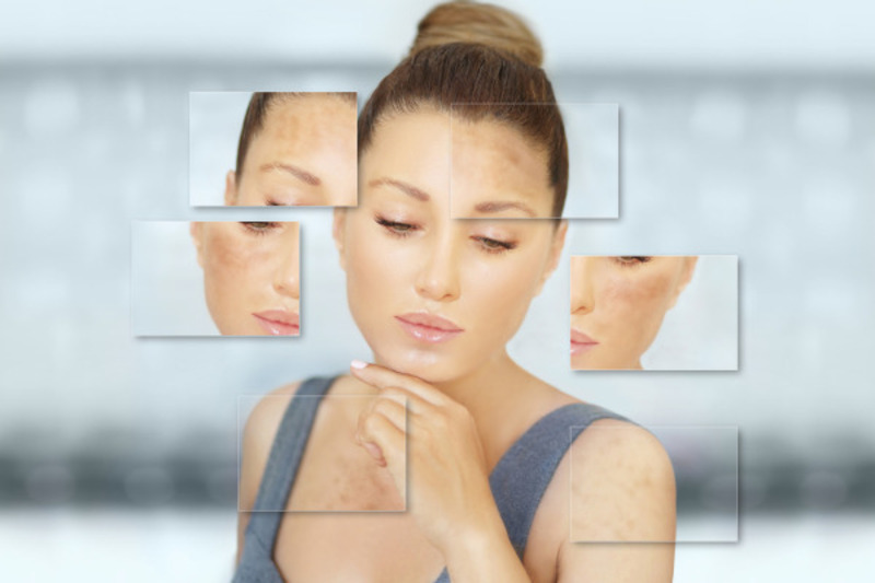 tinh dầu trị nám tàn nhang